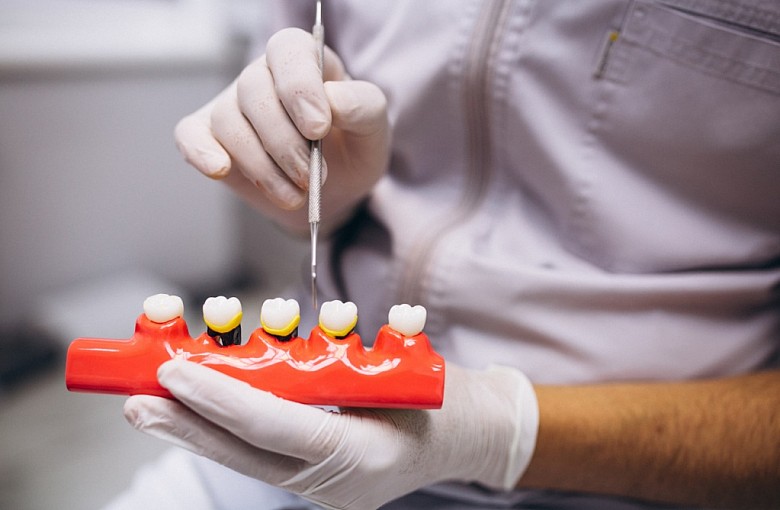Stały most na sześciu implantach – co ustalić przed odbudową całego łuku?